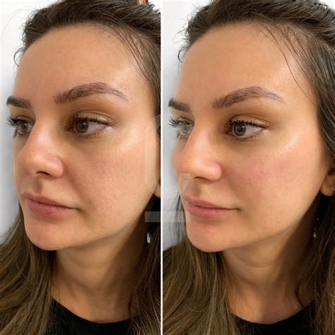 Side-by-side comparison of cheek filler before and after photos, showcasing different treatment outcomes (e.g., 1ml vs. 3ml augmentation).