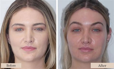 A collage of before-and-after photos showcasing subtle yet effective Botox results