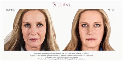 A comparison table highlighting the differences between Sculptra (collagen stimulator) and Hyaluronic Acid fillers (immediate volume).