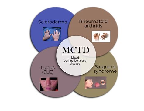 Infographic illustrating the overlap of symptoms in mixed connective tissue disease (MCTD) with lupus, scleroderma, and polymyositis.