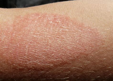Close-up photograph showing the characteristic red, dry, and flaky appearance of eczema on skin.