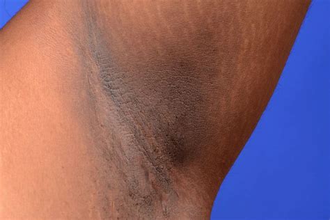 Image showing the characteristic dark, velvety skin of acanthosis nigricans in the armpit area.