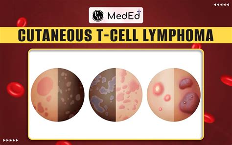 Diagram illustrating the different stages and appearances of cutaneous lymphoma on the skin.