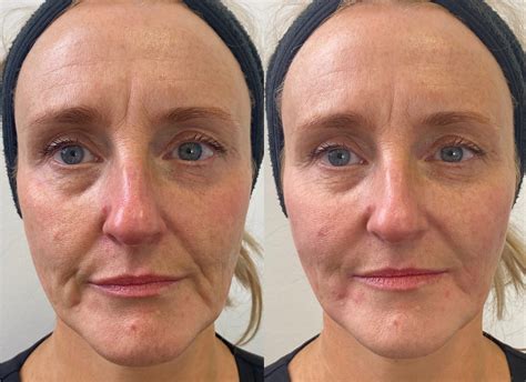 Before and after images of a patient receiving dermal fillers to smooth wrinkles