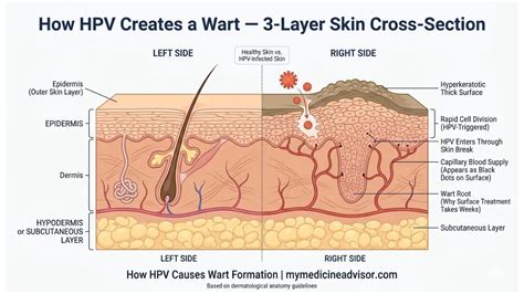 Diagram illustrating the layers of skin and the location of a wart