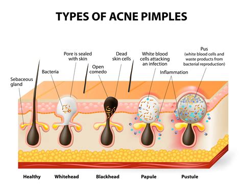 Diagram showing the formation of a cystic acne lesion deep within the skin.