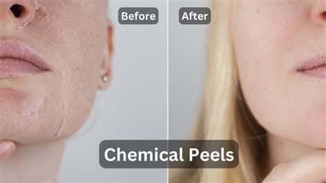 Before and after photos of skin treated with chemical peels