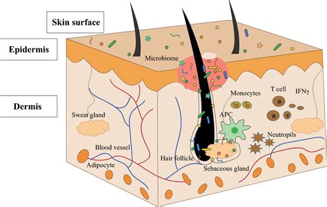 Diagram illustrating the cross-section of a skin pore showing the buildup of oil, dead skin cells, and dirt.