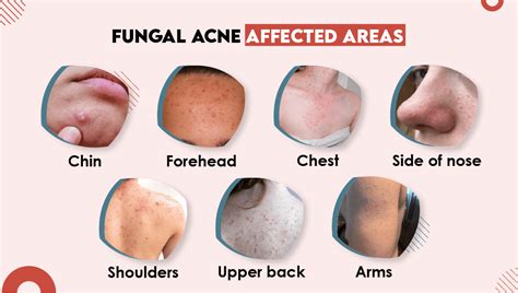 Infographic illustrating the mechanism of selenium sulfide in treating fungal acne by reducing yeast and inflammation in hair follicles.