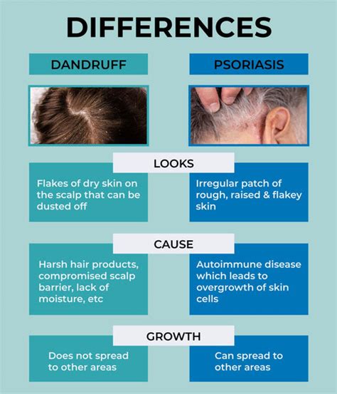 Infographic illustrating the difference between scalp psoriasis and dandruff