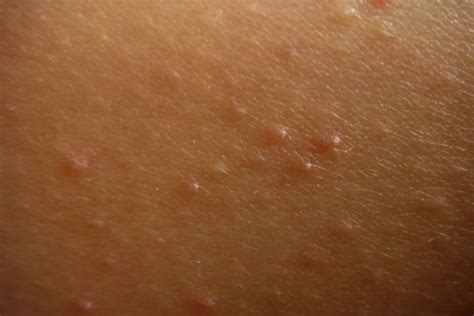 Close-up image of skin showing red bumps and small blisters characteristic of swimmer's itch.