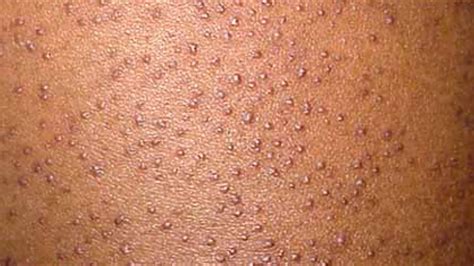 Close-up image of dry, bumpy skin characteristic of keratosis pilaris