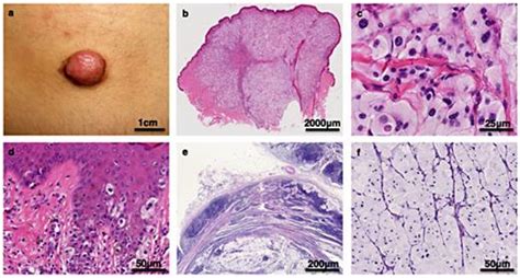 Histological image showing balloon cells in melanoma with abundant clear cytoplasm and vacuolization.