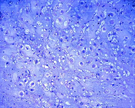 Microscopic image showing balloon-shaped melanocytes with abundant vacuolated cytoplasm and peripheral nuclei.
