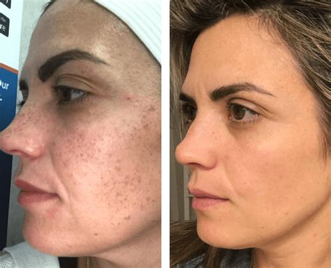 Collage of before-and-after photos showcasing the results of IPL treatments for various skin concerns.
