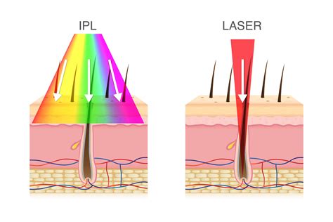 Diagram comparing IPL and laser treatments, highlighting their different light wavelengths and penetration depths.
