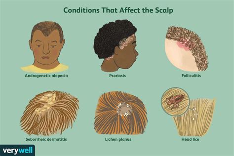 Illustration showing common areas of seborrheic dermatitis on the face and scalp.