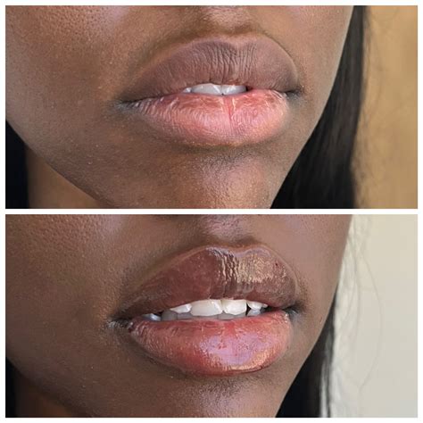 Aesthetic representation of lips before and after augmentation, showcasing increased volume and improved contour.