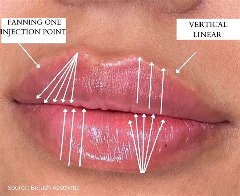 Close-up illustration of dermal filler injection into the lips, highlighting precision and technique.