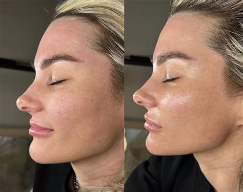 Before and after photos of dermaplaning, showcasing smoother skin and reduced peach fuzz