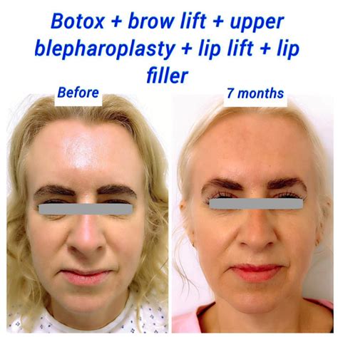 Image showing a patient post-brow lift surgery with mild swelling and bandages, illustrating typical recovery appearance.