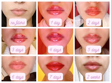 Timeline graphic illustrating the lip filler healing process from day 1 to day 14.