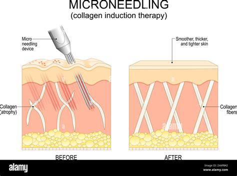 Close-up illustration of microneedling device creating micro-channels on the lip area.