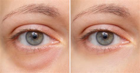 A split image showing a person's tired, puffy eyes before using the product and their refreshed, smoother eyes after application.