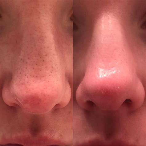Before and after photos showing reduction in blackheads after using the Enzyme Peel Mask