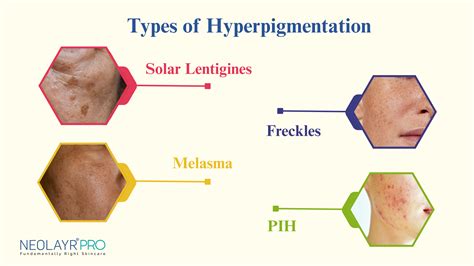 Diagram showing common areas of the face affected by different types of hyperpigmentation.