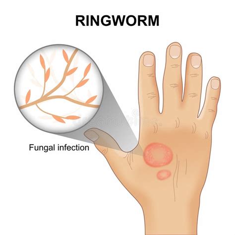 Illustration of typical ringworm lesions on a cat's head and nose.