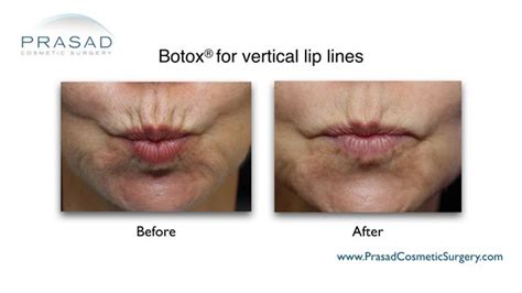 Infographic illustrating the combined treatment approach for vertical lip lines, showing filler, Botox, and laser therapy.