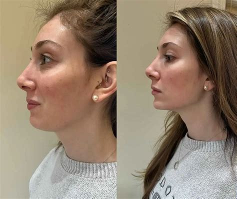 Before and after images showcasing the effect of jawline filler on facial contour.