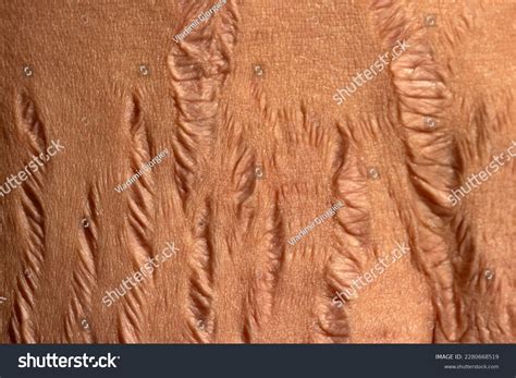 A close-up of skin texture, showing subtle stretch marks.