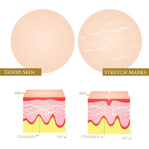 An infographic illustrating the layers of skin and where stretch marks form.