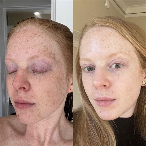 Visual comparison of skin before and after using a Vitamin C derivative, showing improved brightness and reduced dark spots