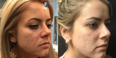 Before and after images showcasing the reduction of acne scars and wrinkles after microneedling treatment.