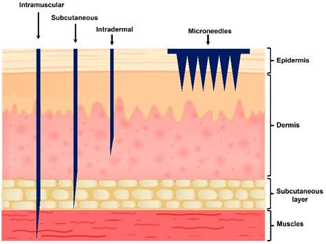 An illustration showing the layers of skin and how microneedles penetrate them during the procedure.