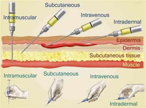 Diagram showing the subcutaneous injection administration of SKYRIZI.