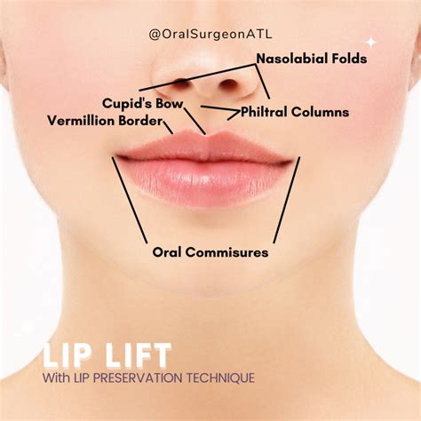 Comparison chart of different lip lift surgical techniques, highlighting incision placement and expected outcomes.