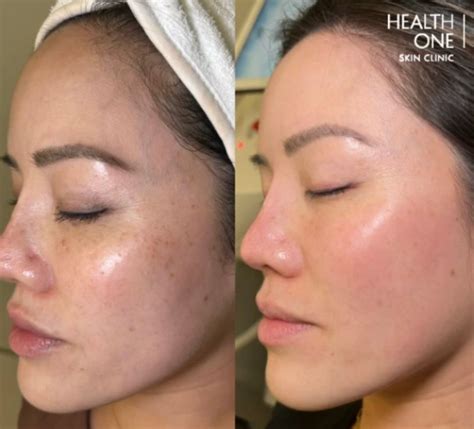 A split image showing before and after treatment for perioral hyperpigmentation, demonstrating significant lightening of dark patches.