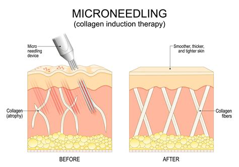 Infographic illustrating the process of microneedling and collagen stimulation.