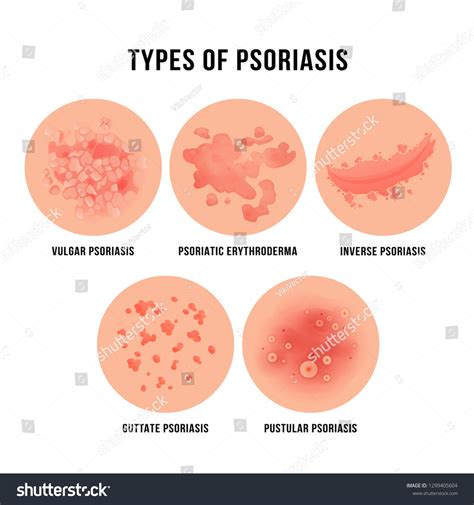 Illustration depicting the characteristic red, scaly patches of psoriasis on the skin.