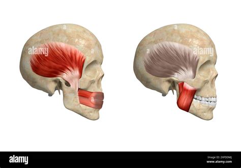 Illustration of the masseter muscles in the jaw