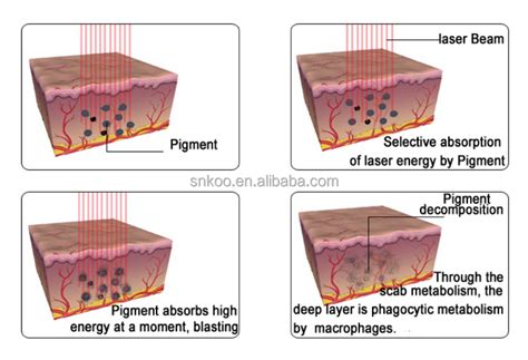 A diagram illustrating how picosecond laser pulses break down pigment particles in the skin.