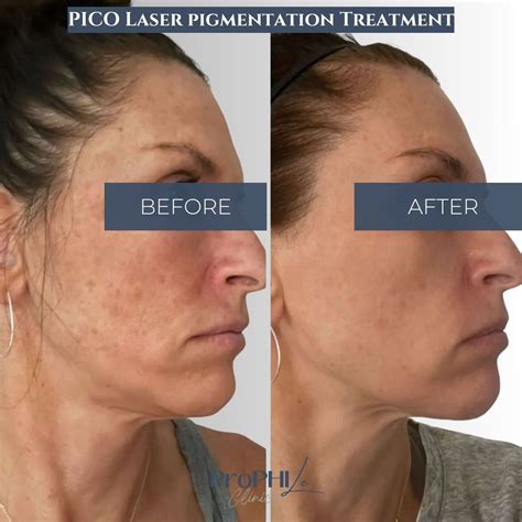 A collage of before and after photos showcasing various Pico Laser treatments: fading tattoos, evening skin tone, and reducing acne scars.