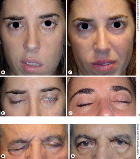 Infographic illustrating the main causes of lagophthalmos after blepharoplasty: nerve damage, excessive skin removal, and scarring.