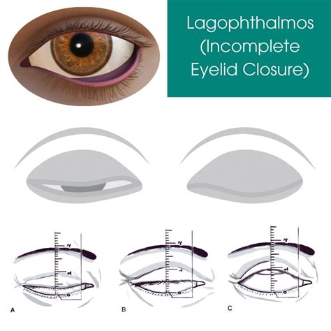 Diagram showing how to measure the eyelid gap in lagophthalmos and illustrating different severity levels.