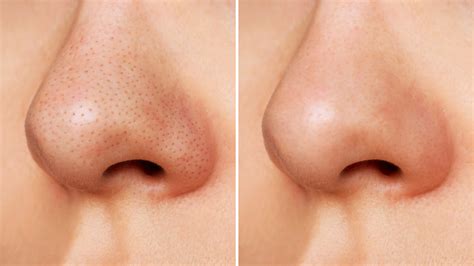 Before and after images showcasing the reduction of blemishes, blackheads, and dark spots on the skin after using the Medik8 Press & Clear Tonic.