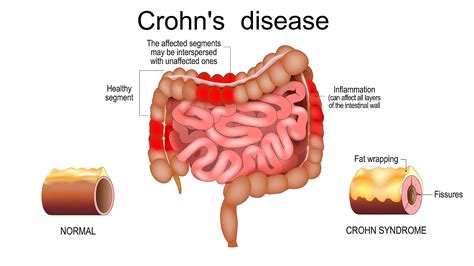 Infographic showing the increased risk percentages of developing Crohn's, UC, and psoriasis in individuals with obesity.